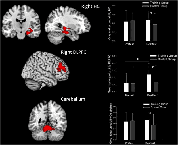 Gray-matter changes after Super Mario training in the Kühn study